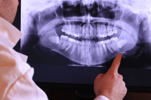 Best Emergency Dental Extractions in Watkins Glen, NY